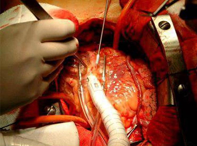 Pembedahan pintasan jantung untuk merawat arteri yang tersumbat dan meningkatkan aliran darah ke jantung