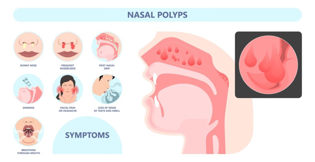 Infographic of nasal polyps symptoms