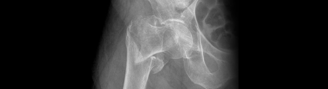 X-ray of a hip fracture caused by a fall related to osteoporosis