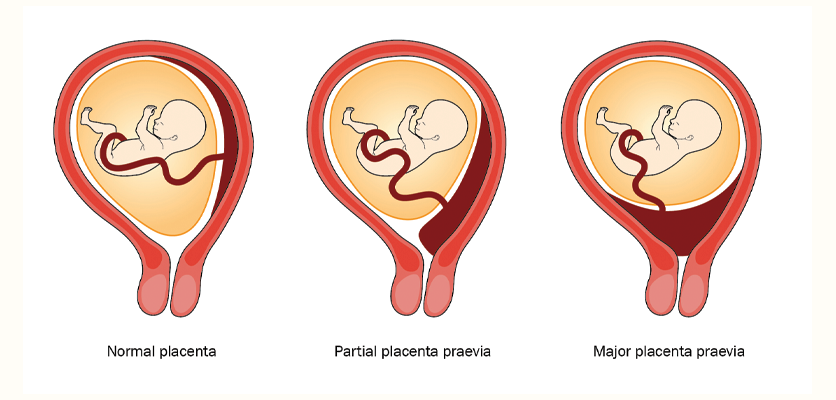 Three types of placenta previa based on the degree of cervical coverage in late pregnancy