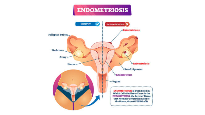 Endometriosis is when tissue grows outside the uterus and may cause pelvic pain, severe period pain, and other symptoms