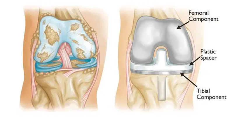 Severe osteoarthritis compared with a total knee implant on the femur and tibia plus a plastic spacer