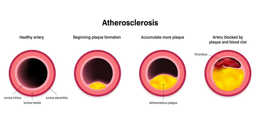 Cross-section of arteries showing plaque buildup stages in atherosclerosis, leading to blood clot and heart risk