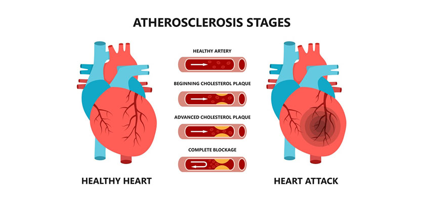 Comparison of a healthy heart versus a blocked artery caused by cholesterol plaque, leading to heart attack risk